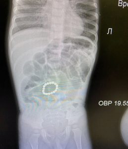 Раменские хирурги извлекли из кишечника полуторагодовалого ребенка 15 деталей магнитного конструктора