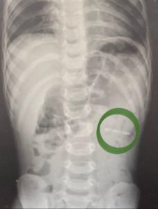 Раменские врачи извлекли из желудка ребёнка крупный ключ от металлической банки